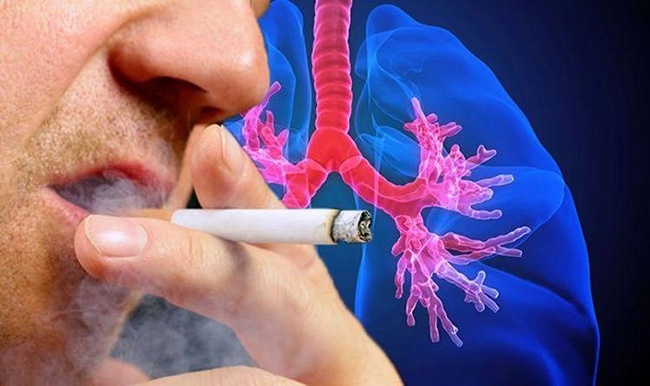 Khói thuốc lá là kẻ thù số một của bệnh u phổi