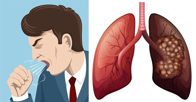 U phổi thường ít có triệu chứng ở giai đoạn đầu